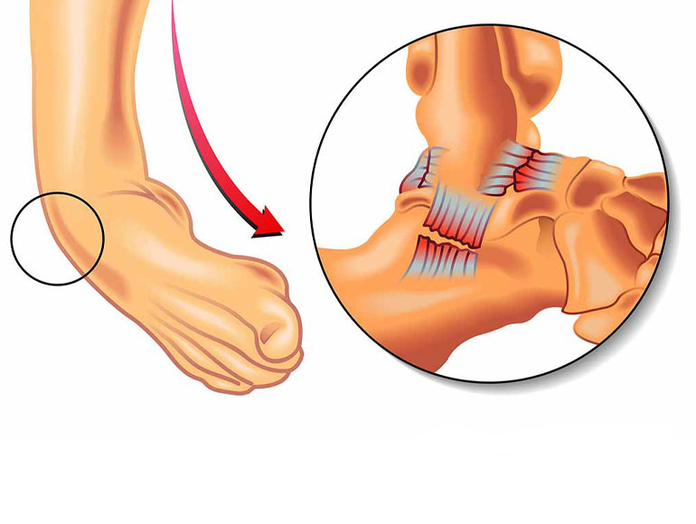 entorse de la cheville en inversion