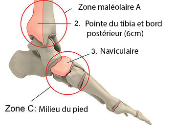 Dois-je me rendre aux urgences pour une entorse de la cheville ? | Attelle cheville