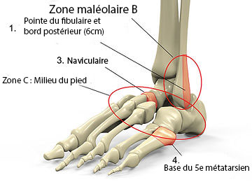 Dois-je me rendre aux urgences pour une entorse de la cheville ? | Attelle cheville